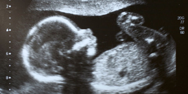 PMA : Le gouvernement ne doit pas céder sur l'égalité (PCF) PMA : Le gouvernement ne doit pas céder sur l'égalité (PCF)