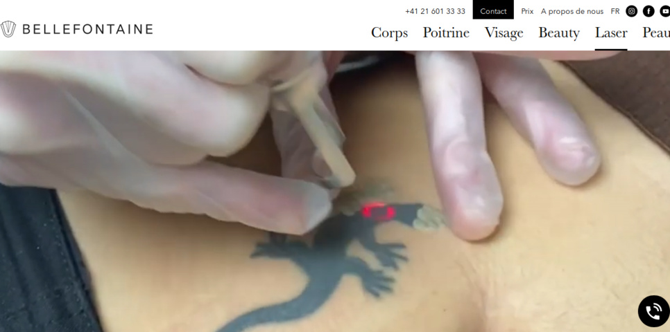 Détatouage Laser Lausanne Détatouage Laser Lausanne