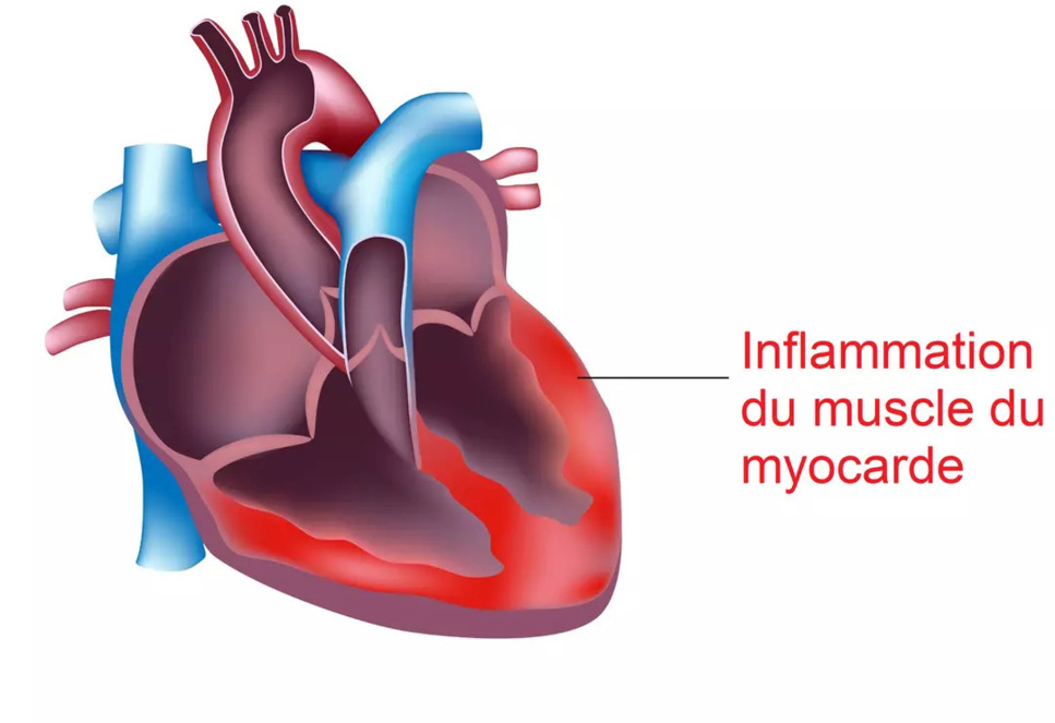 ATTENTION DANGER : Vaccins à ARN : 800 x plus de myocardites ! ATTENTION DANGER : Vaccins à ARN : 800 x plus de myocardites !