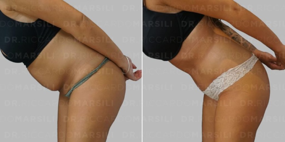 Abdominoplastie Paris, faire une abdominoplasite. Quand, comment, pourquoi ? Abdominoplastie Paris, faire une abdominoplasite. Quand, comment, pourquoi ?