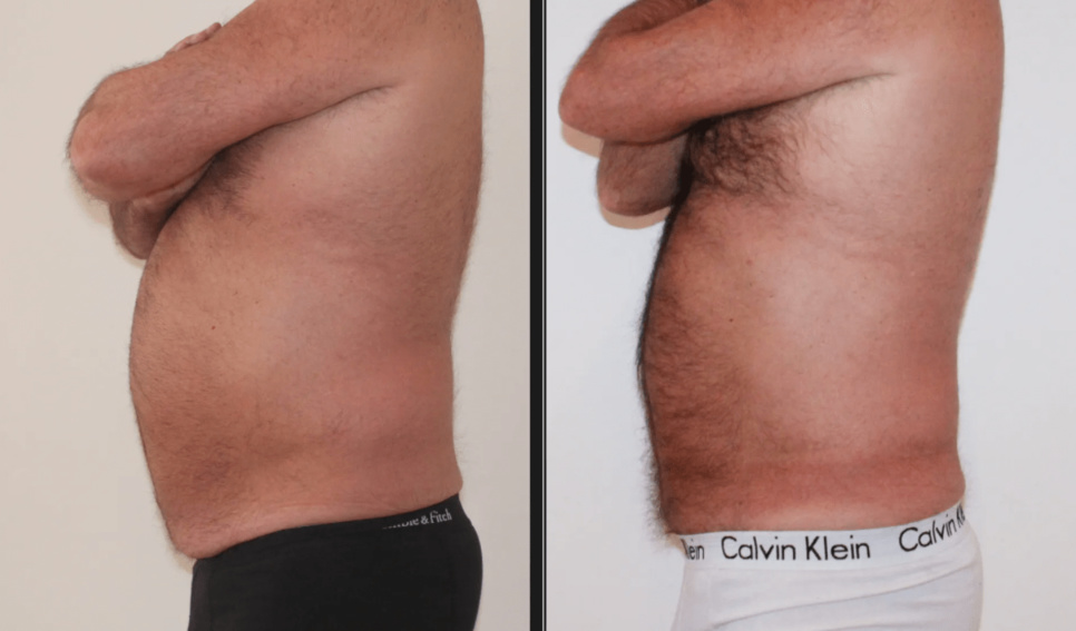 Liposuccion ? Un spécialiste à Genève ? Liposuccion ? Un spécialiste à Genève ?