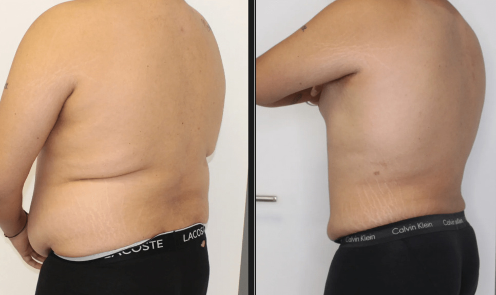 Liposuccion des Bras à Genève en Suisse Liposuccion des Bras à Genève en Suisse