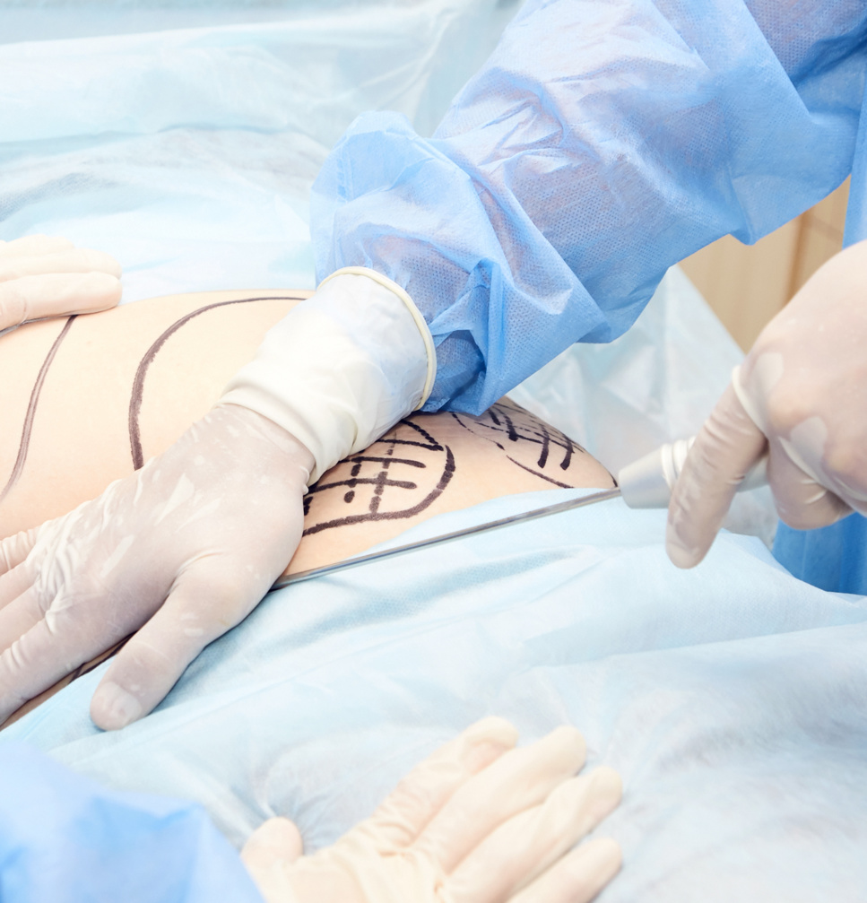 Liposuccion du dos ? Un chirurgien spécialiste de Genève en parle Liposuccion du dos ? Un chirurgien spécialiste de Genève en parle