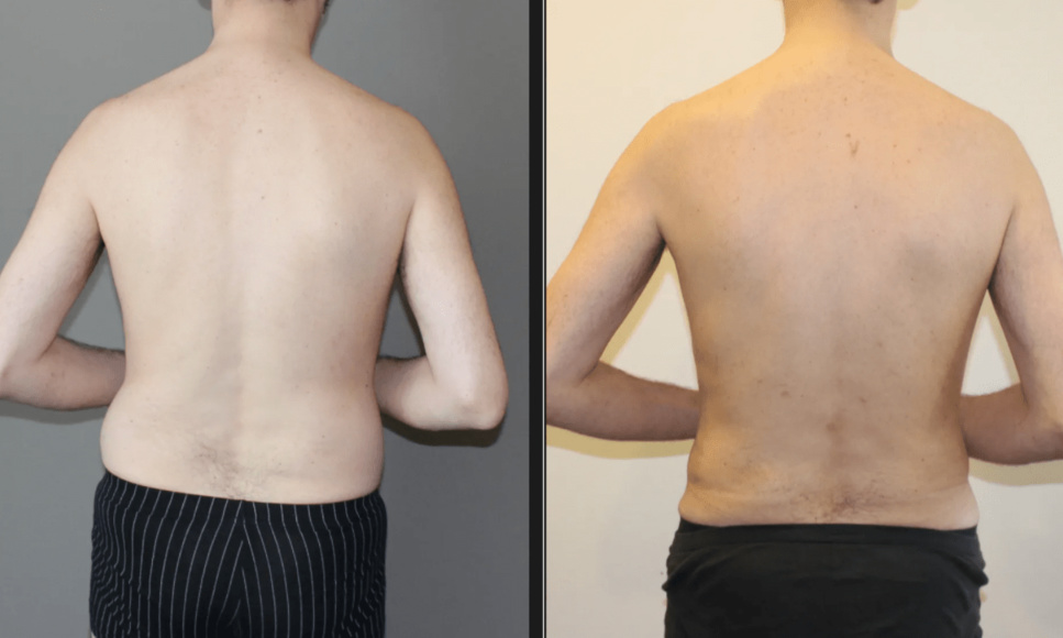 Abdominoplastie Genève, tout savoir ! Le Chirurgien esthétique Dr Tenorio Xavier nous répond ! Abdominoplastie Genève, tout savoir ! Le Chirurgien esthétique Dr Tenorio Xavier nous répond !