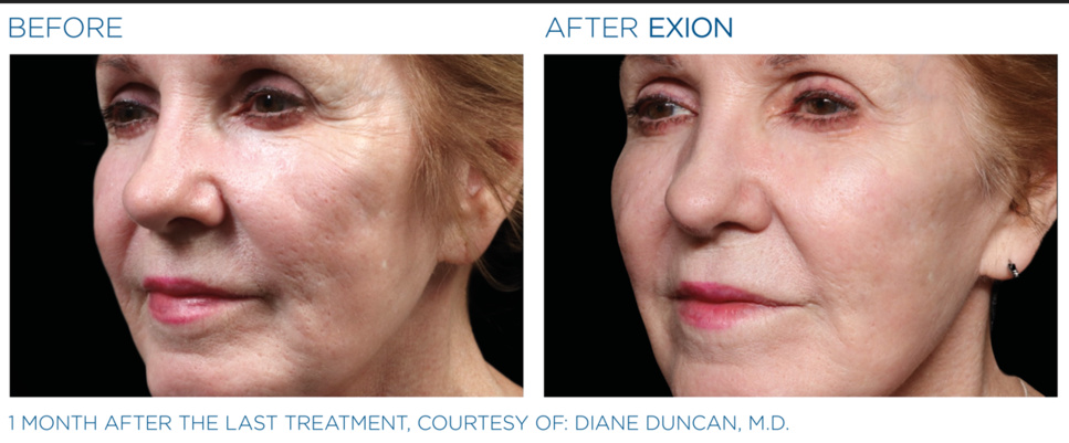 Chirurgie des paupières ou Blépharoplastie, tout savoir sur cette opération des yeux Chirurgie des paupières ou Blépharoplastie, tout savoir sur cette opération des yeux