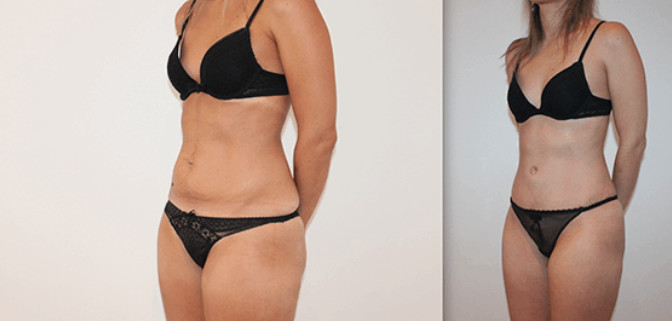 Liposuccion de la silhouette FAQ pour homme et femme