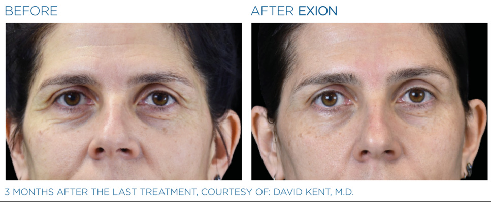 Injection avec acide hyaluronique tous savoir sur cette prestation de médecine esthétique Injection avec acide hyaluronique tous savoir sur cette prestation de médecine esthétique