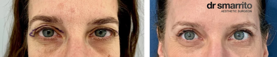 Quoi faire pour les yeux en médecine esthétique ? Quoi faire pour les yeux en médecine esthétique ?