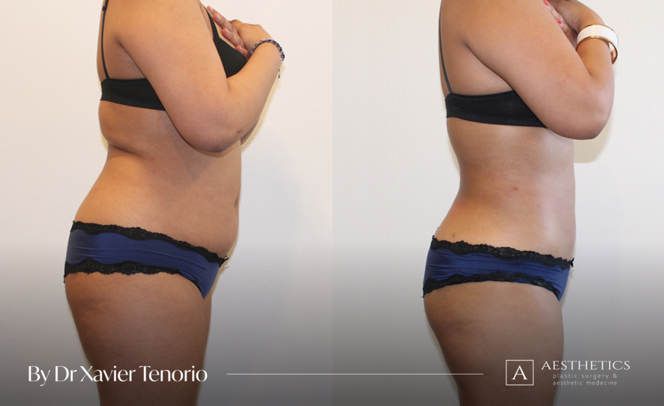 Liposuccion, Le Dr Xavier Tenorio de Genève nous explique les nouveautés Liposuccion, Le Dr Xavier Tenorio de Genève nous explique les nouveautés