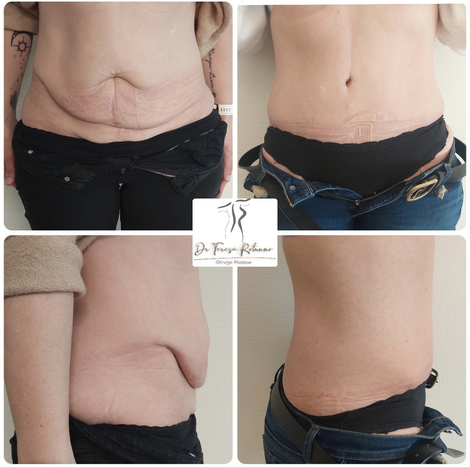 Abdominoplastie, le Docteur Teresa Rotunno répond à des questions Abdominoplastie, le Docteur Teresa Rotunno répond à des questions