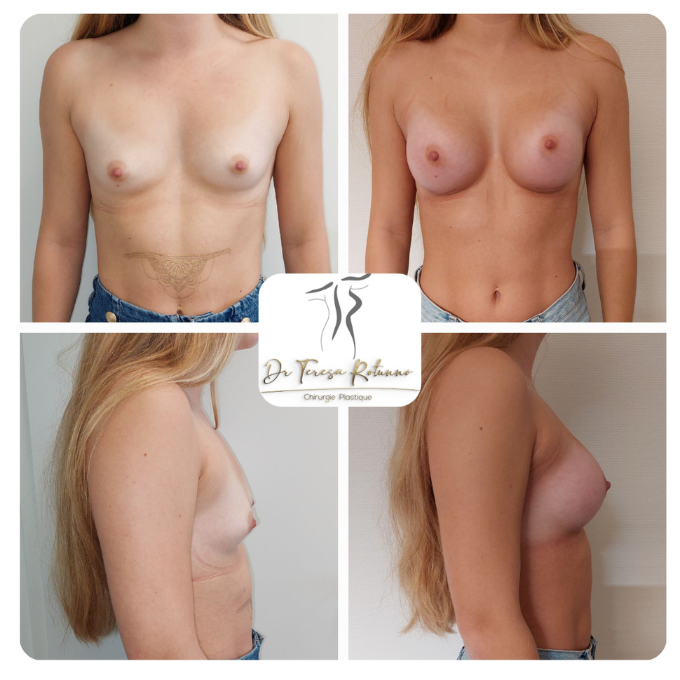 Augmentation mammaire par prothèses : Docteure Rotunno de Genève nous en parle Augmentation mammaire par prothèses : Docteure Rotunno de Genève nous en parle