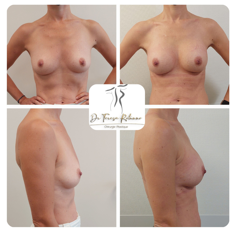 Réduction mammaire en Europe Réduction mammaire en Europe