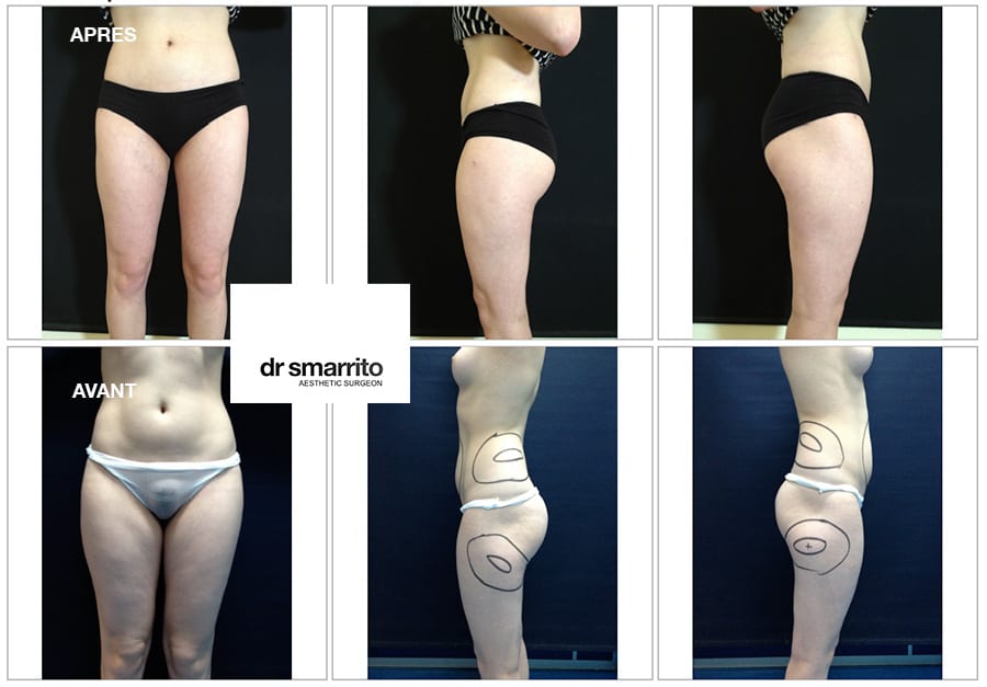 Liposuccion des cuisses, le Docteur Smarrito de Lausanne nous répond