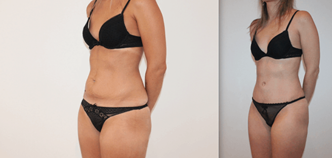 Liposuccion de la silhouette FAQ pour homme et femme