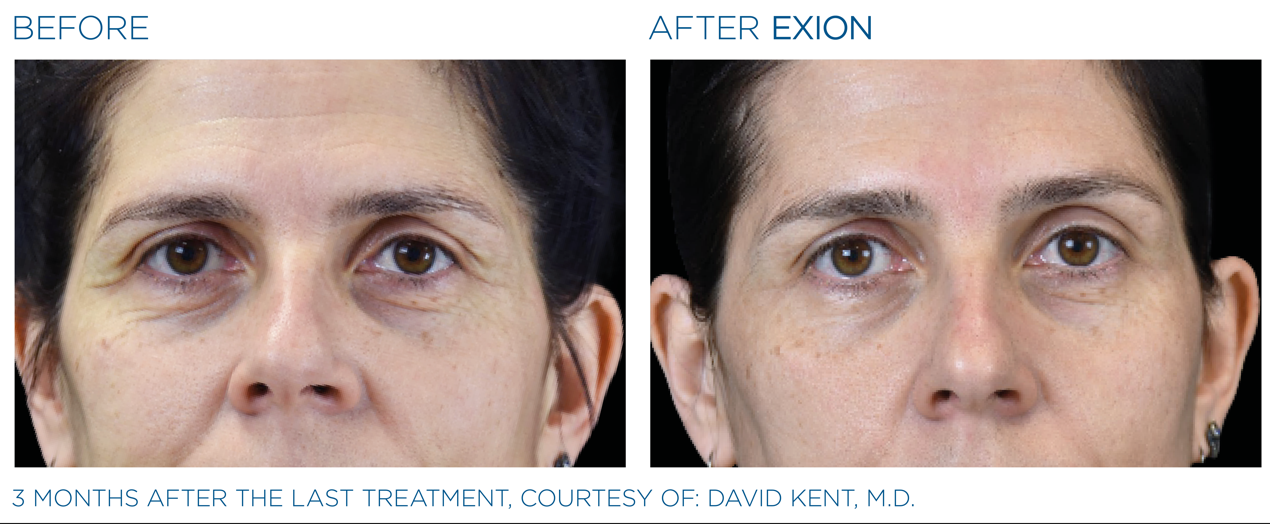 Injection avec acide hyaluronique tous savoir sur cette prestation de médecine esthétique