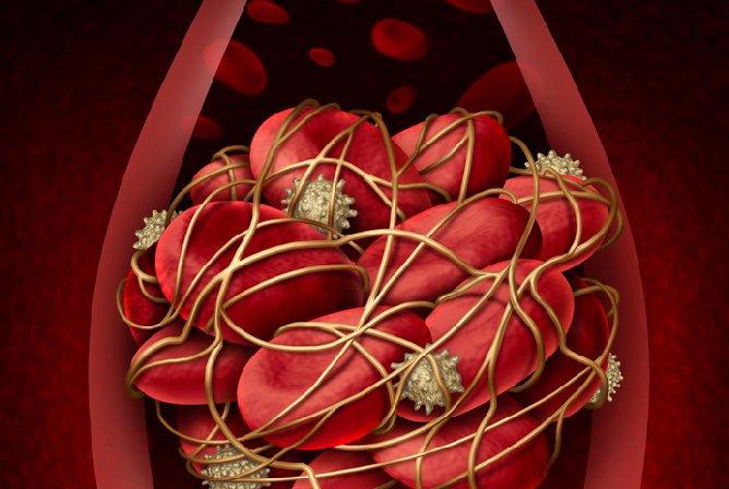 Thrombose veineuse: quels sont les risques?