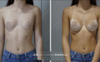 Augmentation mammaire avant et après - photos à voir