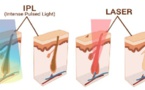 Lausanne Clinic : épilation laser 