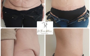 Abdominoplastie, le Docteur Teresa Rotunno répond à des questions