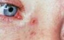 Santé: dépistage des cancers de la peau