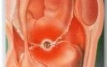 Santé: arthrite et selenium