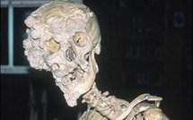 Santé: Elephant Man et sa génétique