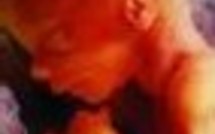 Deux foetus dans un foetus