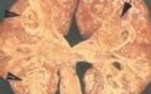 Le vaccin anti-tuberculose