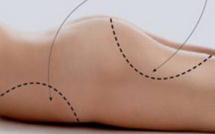 Liposuccion Genève, refaire sa silhouette