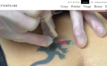 Détatouage Laser Lausanne, questions et réponses