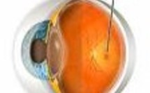 Santé: un espoir dans la dégénérescence maculaire liée à l'âge