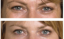 Faire une blépharoplastie en Suisse