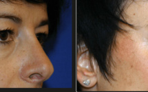 La convalescence après une blépharoplastie ?