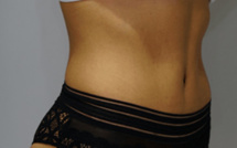 Abdominoplastie en Suisse, où faire l'opération ?