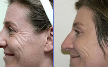 Bienfaits psychologiques de la chirurgie esthétique