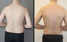 Abdominoplastie Genève, tout savoir ! Le Chirurgien esthétique Dr Tenorio Xavier nous répond !