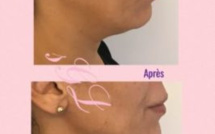 Acide hyaluronique pour la Jawline, le Dr Grept Locher nous en parle