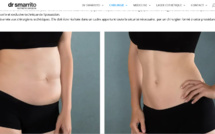 Cryolipolyse, le Dr Smarrito de Lausanne réponds à nos questions