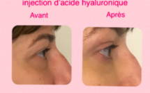 Acide hyaluronique pour les rides, le Dr Grept Locher de Genève répond à nos questions