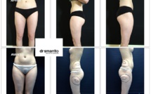 Liposuccion des cuisses, le Docteur Smarrito de Lausanne nous répond
