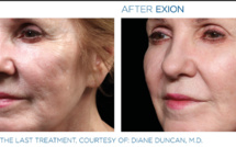 Chirurgie des paupières ou Blépharoplastie, tout savoir sur cette opération des yeux