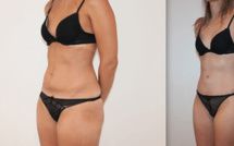 Liposuccion de la silhouette FAQ pour homme et femme