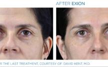 Injection avec acide hyaluronique tous savoir sur cette prestation de médecine esthétique