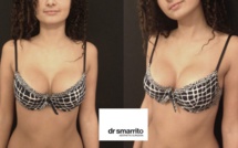 Augmentation mammaire quelle est la dimension psychologique, le Docteur Stéphane Smarrito nous en parle