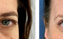 Quoi faire pour les yeux en médecine esthétique ?
