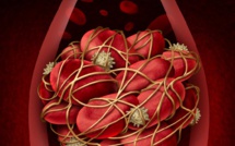 Thrombose veineuse: quels sont les risques?