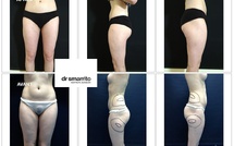 Choisir le bon spécialiste en liposuccion