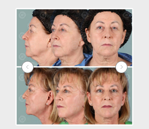 Skinbooster Lausanne, les questions à se poser