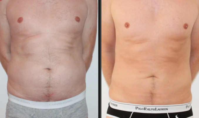 Abdominplastie ou plastie abdominale ? Un spécialiste à Genève Abdominplastie ou plastie abdominale ? Un spécialiste à Genève