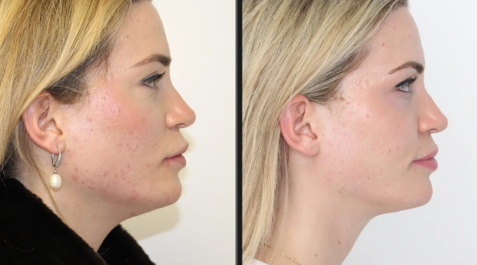 Avoir des beaux yeux grâce à la Blépharoplastie Avoir des beaux yeux grâce à la Blépharoplastie